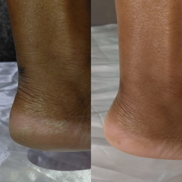 Antes X Depois (Post para Instagram (45)) (6)